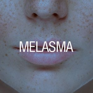 Tratamiento para la Melasma