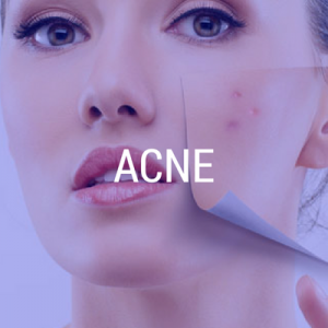Tratamento para acne